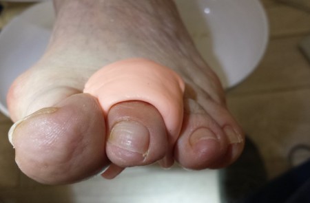 Ortoplastia, ortesi di silicone