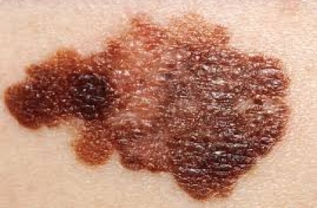 Melanoma