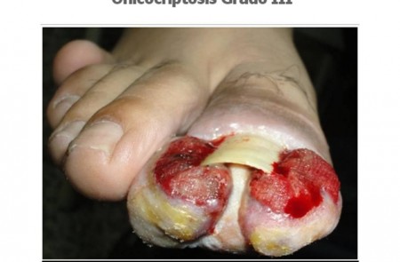 Unghia incarnita, onicocriptosi, ingrow toenail, unha encravada