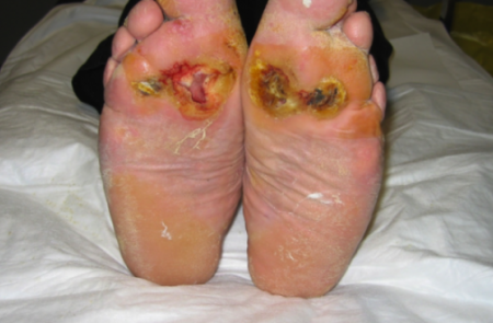 Piede diabetico