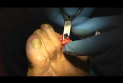 Embedded thumbnail for Intervento di artroplastica quarto dito del piede per ridurre una condizione di dito a martello