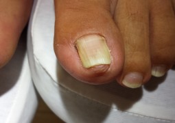Unghia incarnita, onicocriptosi, ingrow toenail,unha encravada