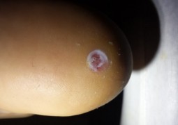 Verruca del tallone in trattamento