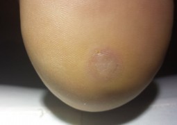 Risoluzione verruca del tallone
