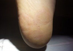 Risoluzione verruche multiple del tallone