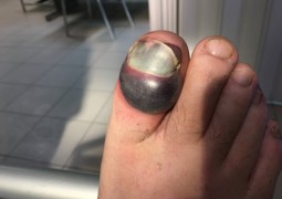 Grave ematoma di origine traumatica alluce piede dx