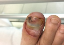 Dopo cinque giorni dal drenaggio dell'ematoma