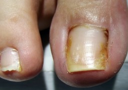 Unghia incarnita, onicocriptosi, ingrow toenail,unha encravada