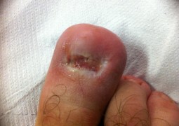 Unghia incarnita, onicocriptosi, ingrow toenail,unha encravada