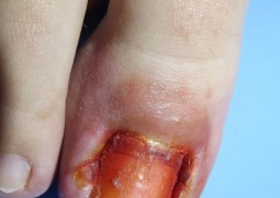 Unghia incarnita, onicocriptosi, ingrow toenail,unha encravada