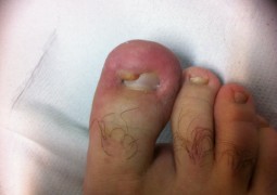 Unghia incarnita, onicocriptosi, ingrow toenail,unha encravada