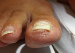 Unghia incarnita, onicocriptosi, ingrow toenail,unha encravada