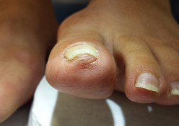 Unghia incarnita, onicocriptosi, ingrow toenail,unha encravada