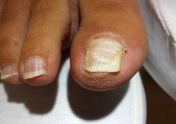 Unghia incarnita, onicocriptosi, ingrow toenail,unha encravada