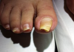 Unghia incarnita, onicocriptosi, ingrow toenail,unha encravada