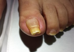 Unghia incarnita, onicocriptosi, ingrow toenail,unha encravada