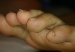 Verruche, HPV