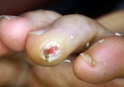 Verruche, HPV