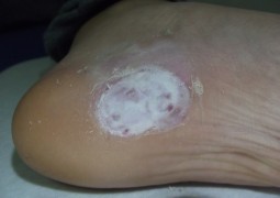 Verruche, HPV