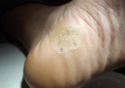 Verruche, HPV