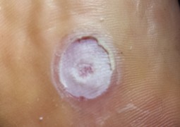 Verruche, HPV