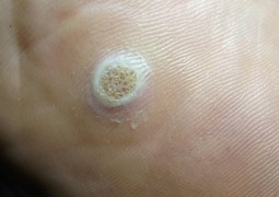 Verruche, HPV