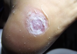 Verruche, HPV