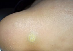 Verruche, HPV