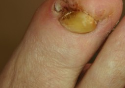 Verruche, HPV