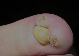 Verruche, HPV