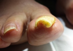 Unghia incarnita, onicocriptosi, ingrow toenail,unha encravada