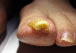 Unghia incarnita, onicocriptosi, ingrow toenail,unha encravata